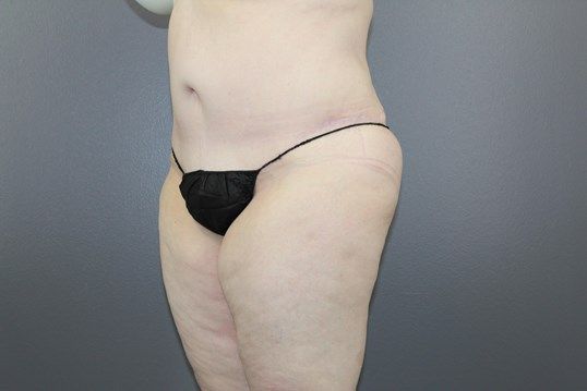 Surgery After Weight Loss Before & After