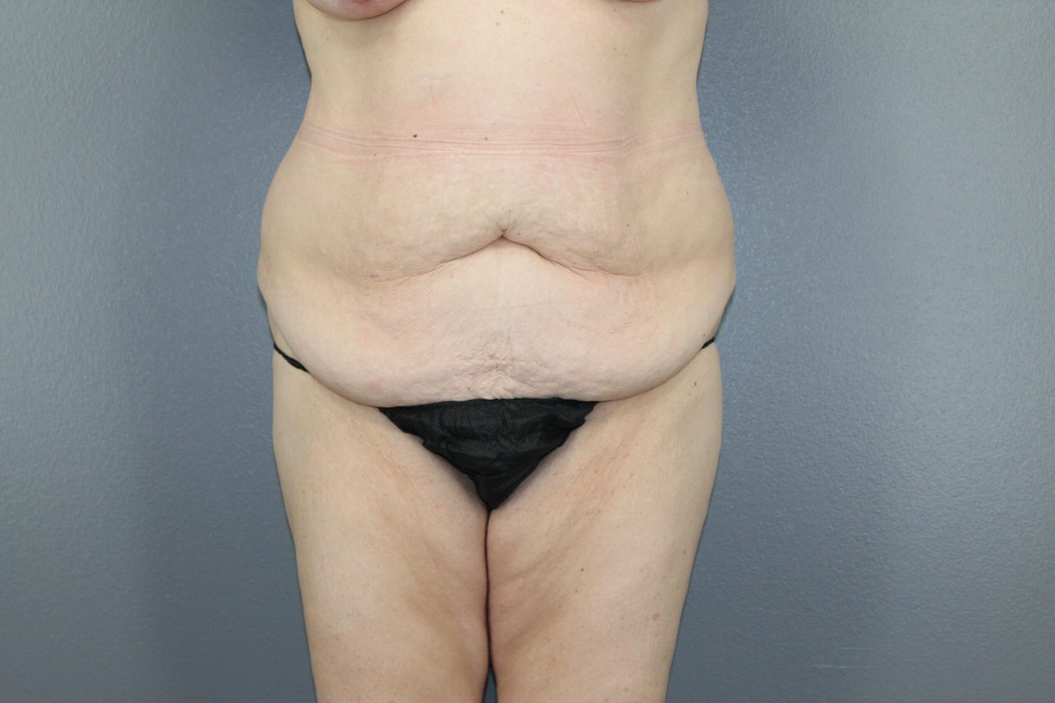 Surgery After Weight Loss Before & After