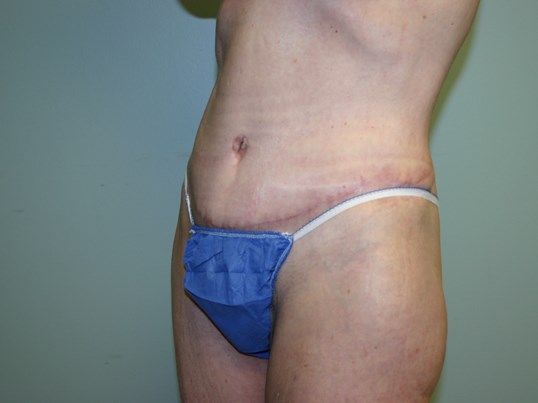 Surgery After Weight Loss Before & After