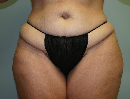 Surgery After Weight Loss Before & After