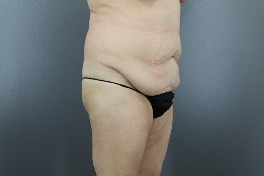 Surgery After Weight Loss Before & After