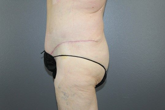 Surgery After Weight Loss Before & After