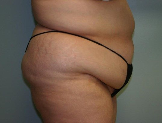 Surgery After Weight Loss Before & After