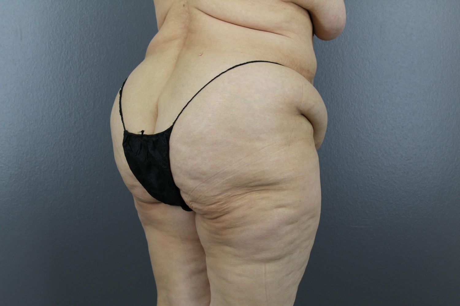 Surgery After Weight Loss Before & After