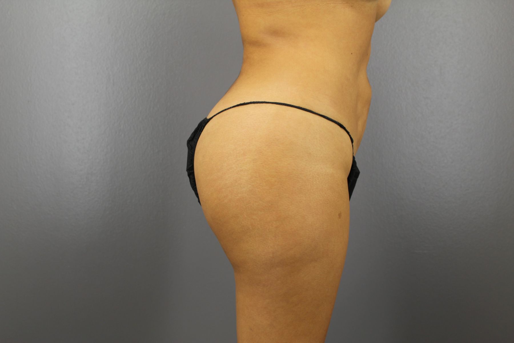Liposuction and fat transfer