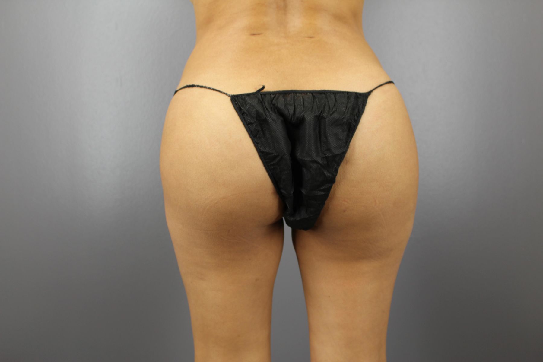 Fat transfer buttocks before and after