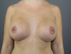 breast-surgery-6