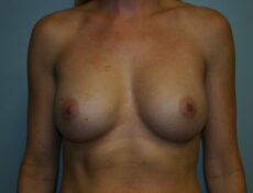 breast-surgery-5