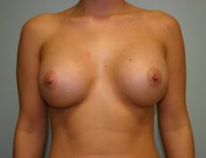 breast-surgery-3