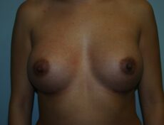 breast-surgery-1