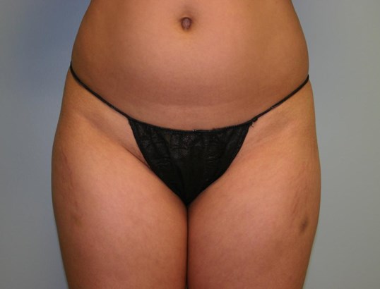 Before liposuction