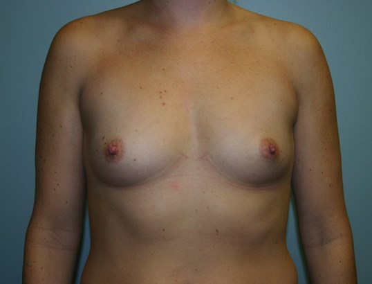 Breast augmentation in Houston