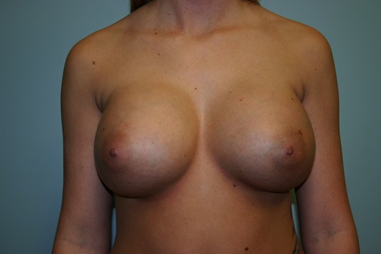 Breast revision specialist