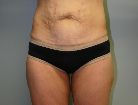 Thigh lift before and after photos