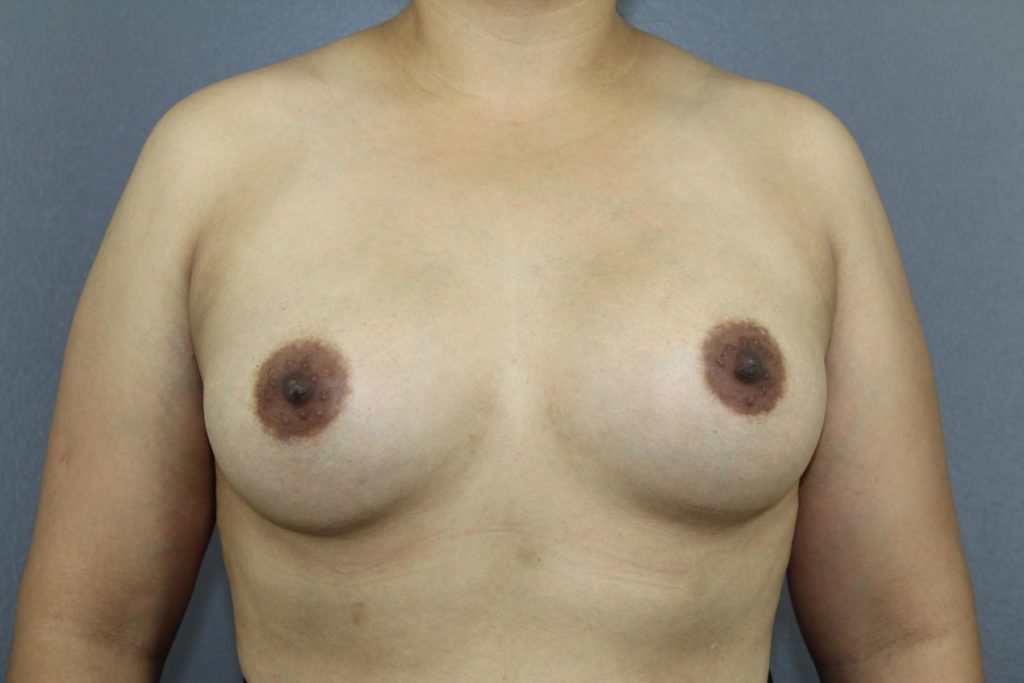 Breast augmentation options