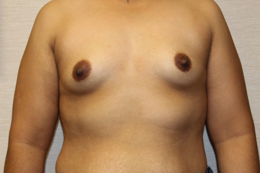 Breast augmentation before after photos