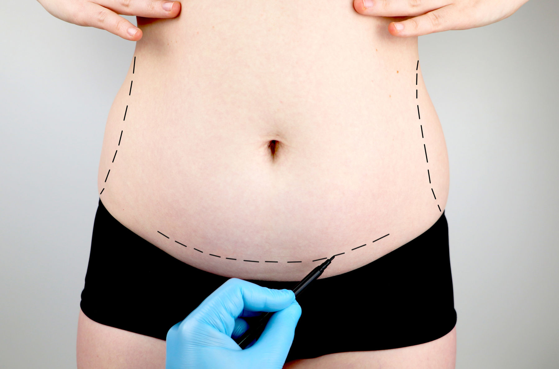 18 Questions to Ask Before Getting a Tummy Tuck - Leo Lapuerta Plastic  Surgery