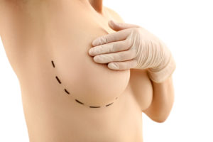how to sleep after breast surgery
