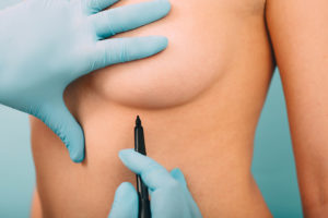 Plastic surgeon marks where his incisions will be for breast surgery.