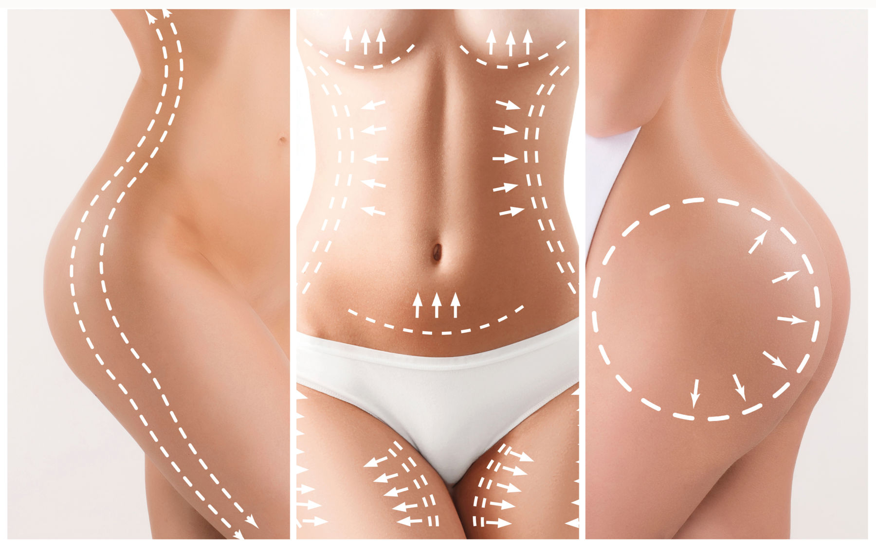 Which Brazilian Butt Lift Shape Is Right For You? - Cosmos Clinic