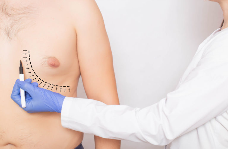 When to Consider Men’s Gynecomastia Surgery