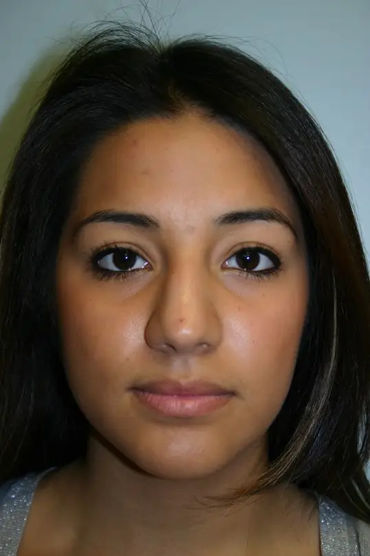 Before Houston Texas rhinoplasty