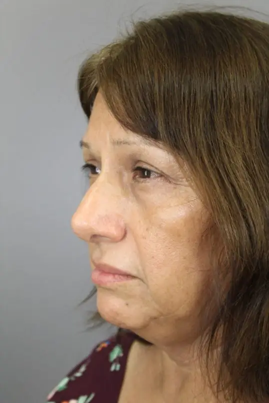 Rhinoplasty after surgery