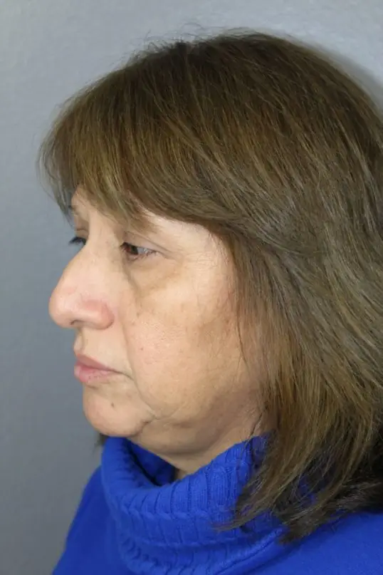 Before Houston plastic surgery Rhinoplasty